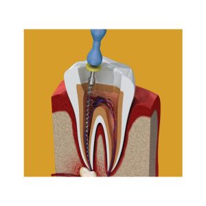 Root canal Dental service pricing