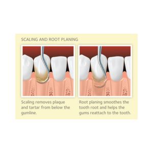 Scaling Treatment