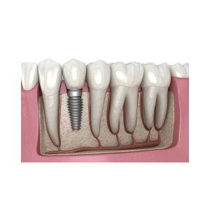 Dental Implants