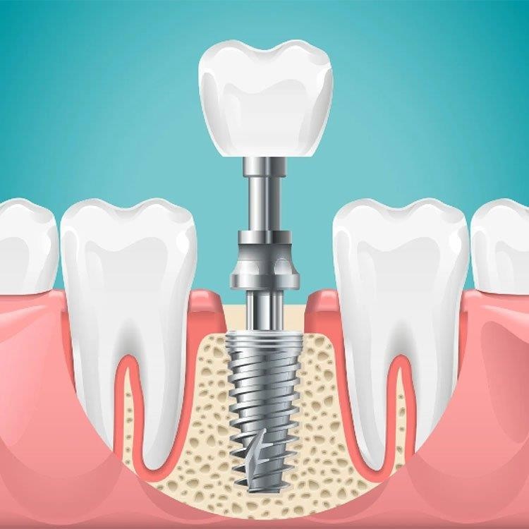 Why to prefer on getting your dental implants from The Dental Hub Gurgaon instead of traditional tooth replacement