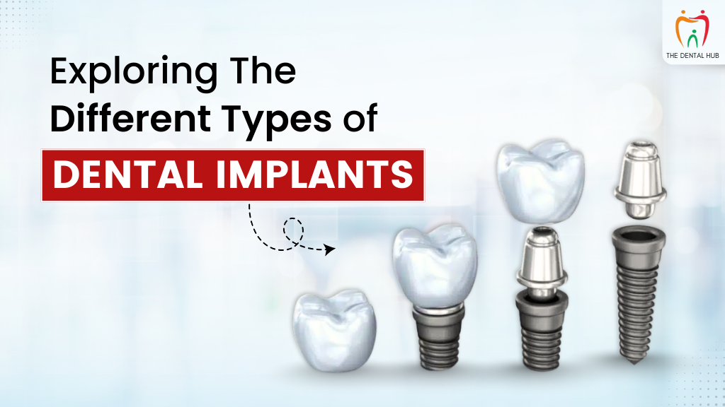 Exploring The Different Types of Dental Implants