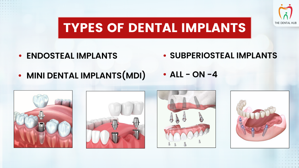 types of dental implants