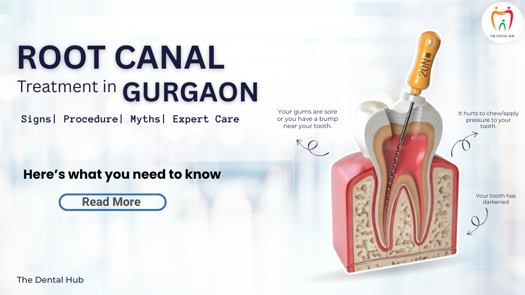 Root Canal Treatment in Gurgaon: Signs, Procedure, Myths & Expert Care at The Dental Hub