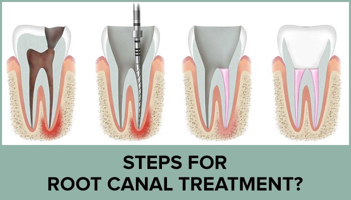 steps of root cananl treatment