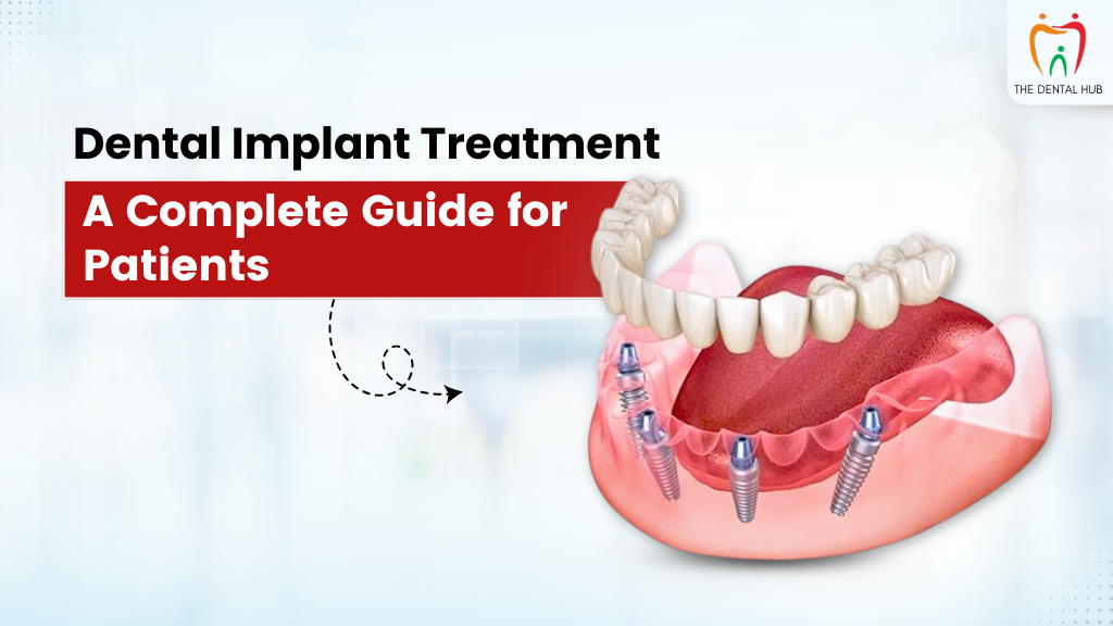 Dental Implant Treatment – A Complete Guide for Patients